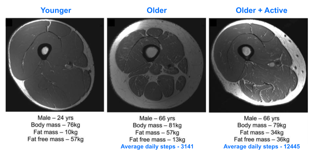 Examples of loss of skeletal muscle size and quality during healthy aging.